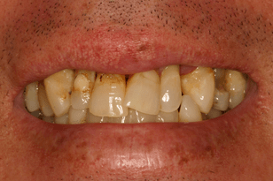 Patient 12 - Fragile teeth