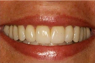 Patient 7 - Teeth discoloration