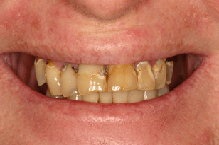 Patient 10 - Breaking teeth