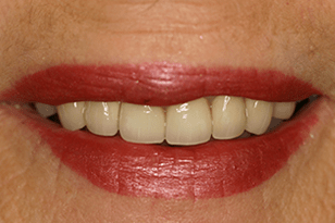 Patient 14 - Broken and discoloured teeth