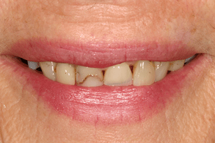 Patient 14 - Broken and discoloured teeth