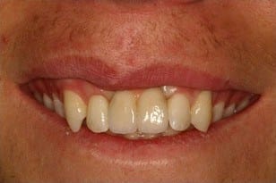 Patient 4 - Two Smashed Front Teeth