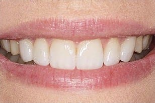 Patient 9 - Teeth wearing and chipping
