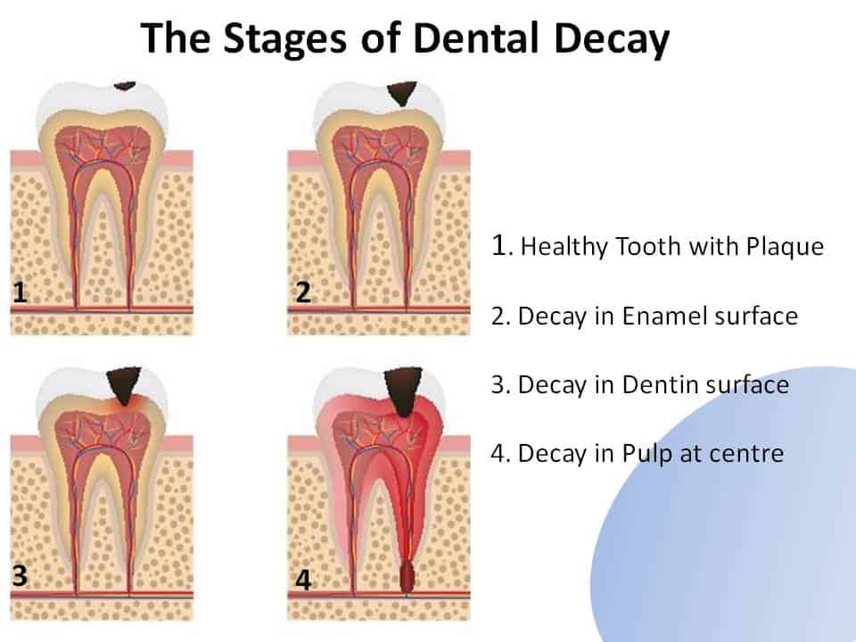The Stages of Dental Decay