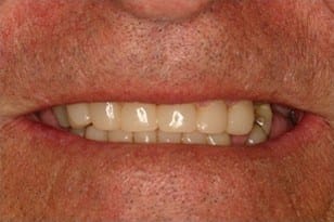 Patient 2 - Severely worn teeth