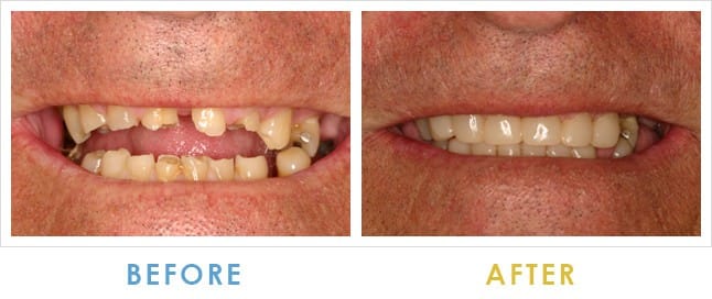 Before and After Bone Augmentation