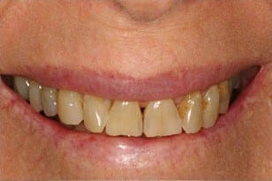 Patient 8 - Weak teeth