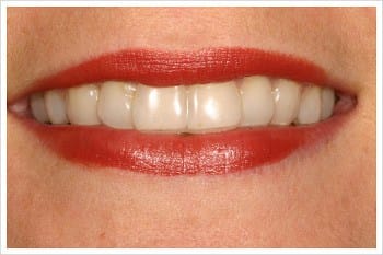 Straighter Teeth - Invisalign
